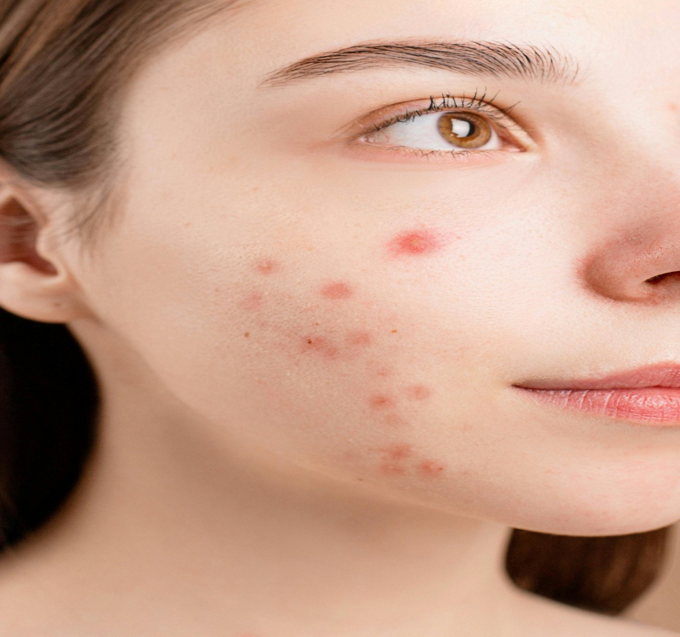  A picture of a woman with acne on her face